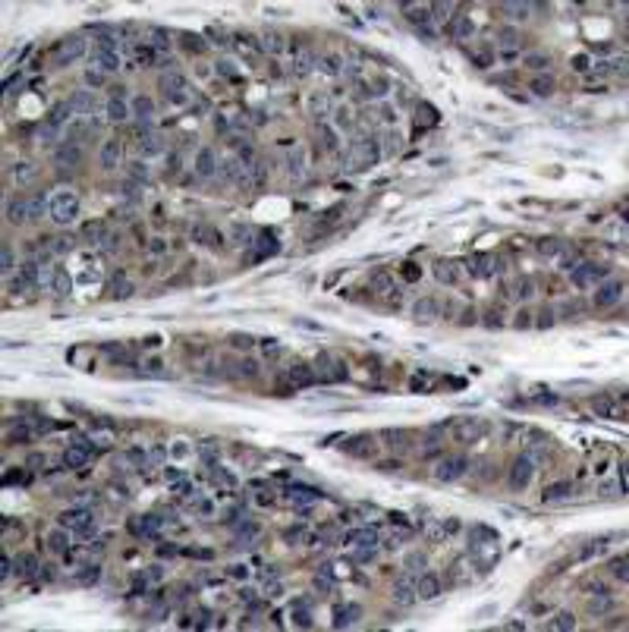 Immunohistochemical analysis of paraffin-embedded human breast carcinoma tissue using NF&#954;B-p105/p50 (Ab-932) .
