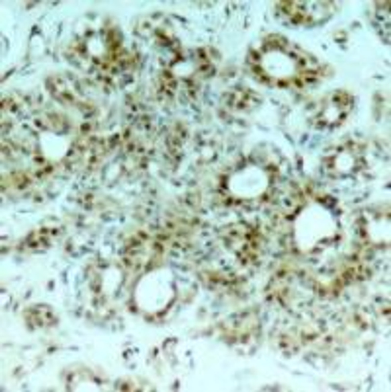 Immunohistochemical analysis of paraffin-embedded human breast carcinoma tissue using NF&#954;B-p65 (Ab-311) .