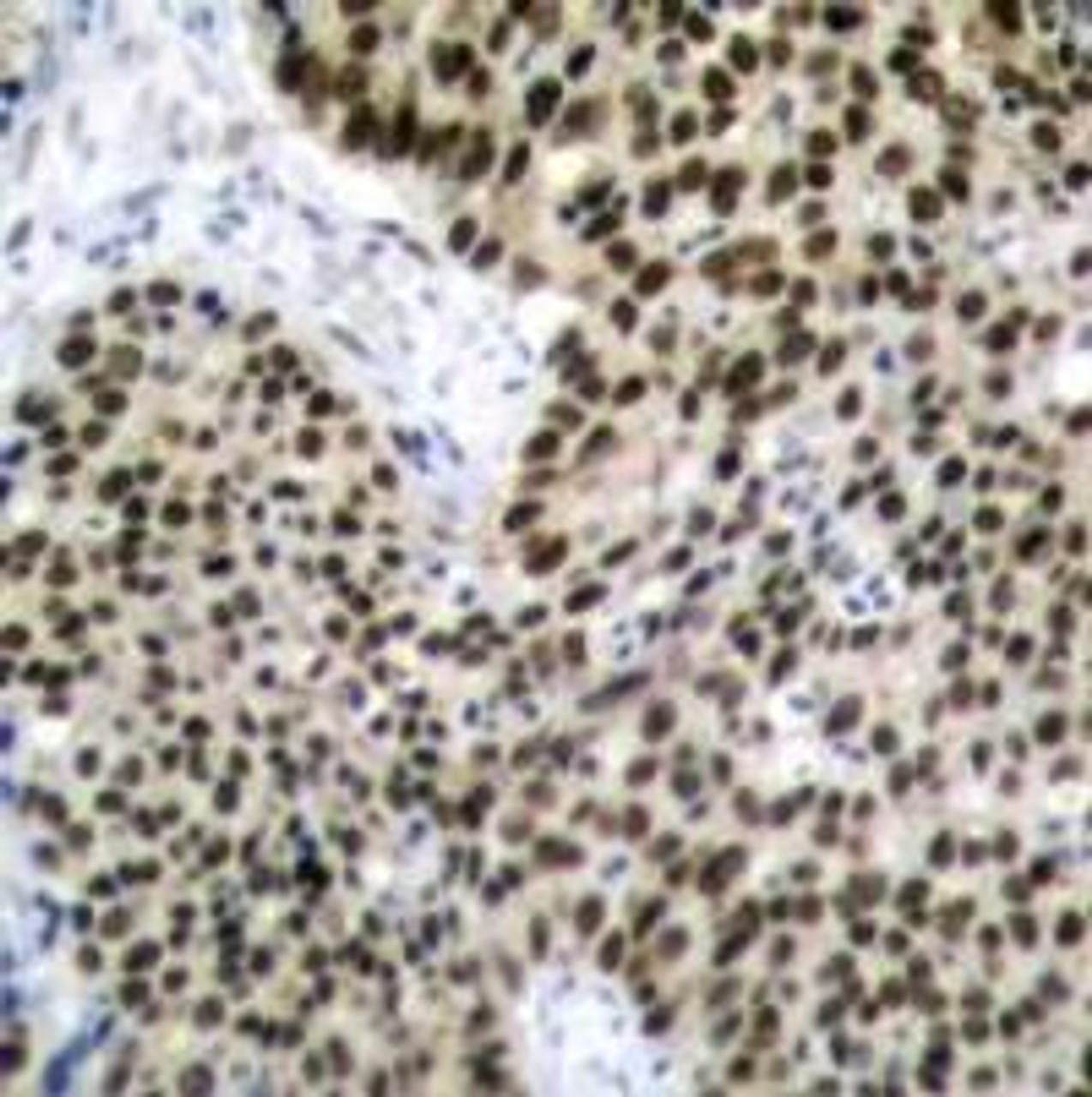 Immunohistochemical analysis of paraffin-embedded human breast carcinoma tissue using HSF1 (Ab-303) .