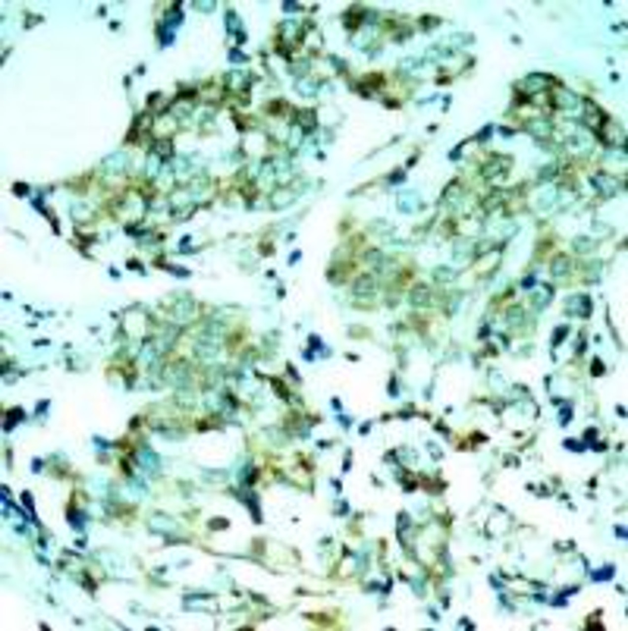 Immunohistochemical analysis of paraffin-embedded human breast carcinoma tissue using EGFR (Ab-1110) .