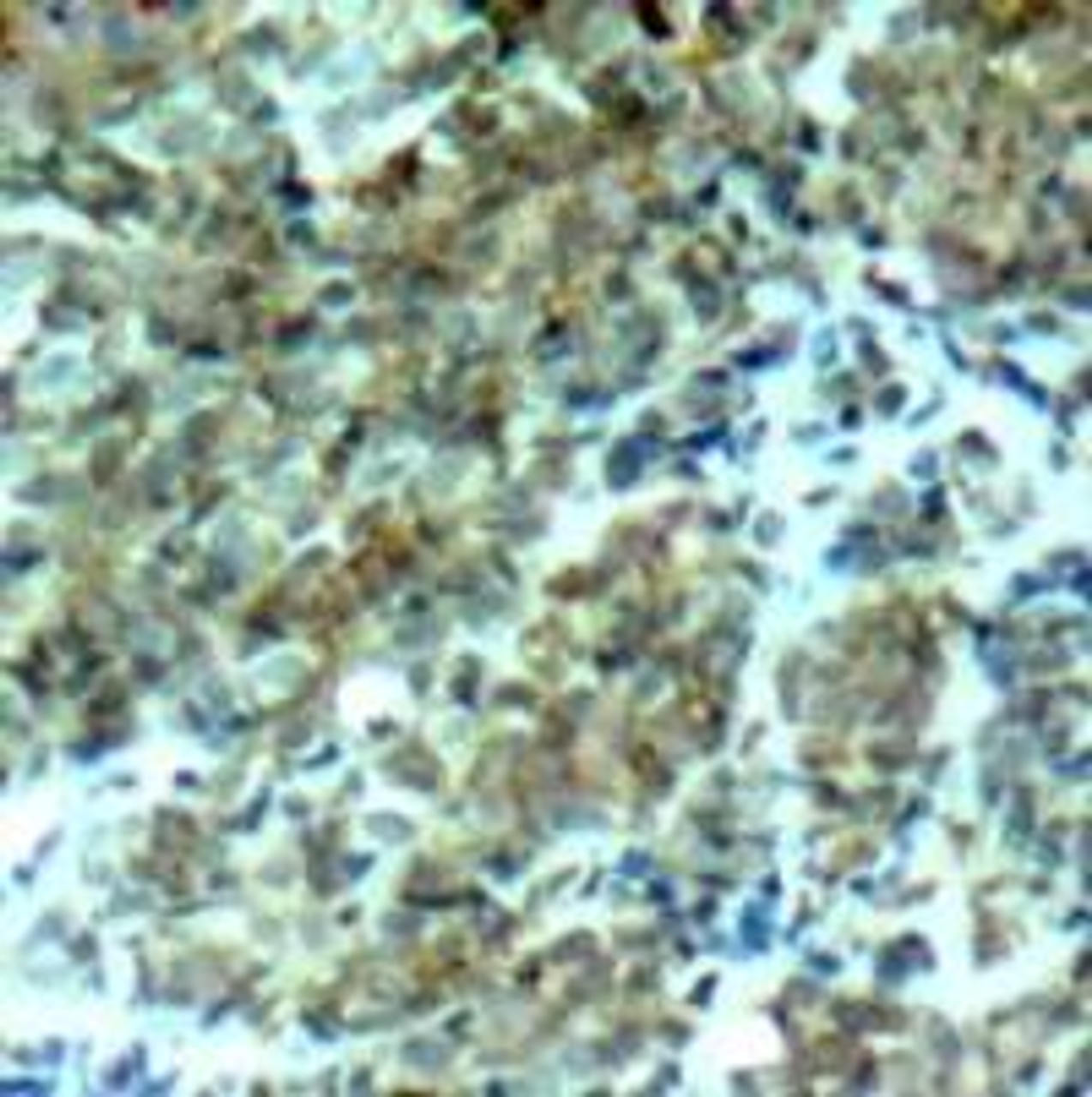 Immunohistochemical analysis of paraffin-embedded human breast carcinoma tissue using Cortactin (Ab-466) .