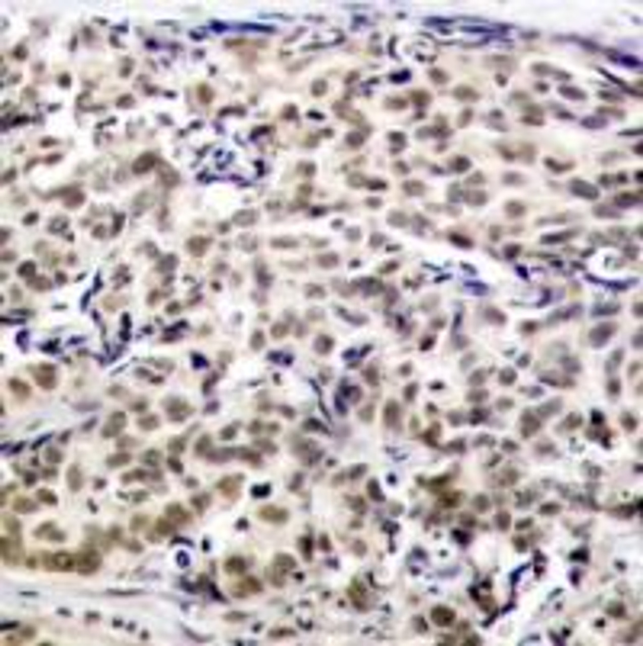 Immunohistochemical analysis of paraffin-embedded human breast carcinoma tissue using CREB (Ab-129) .