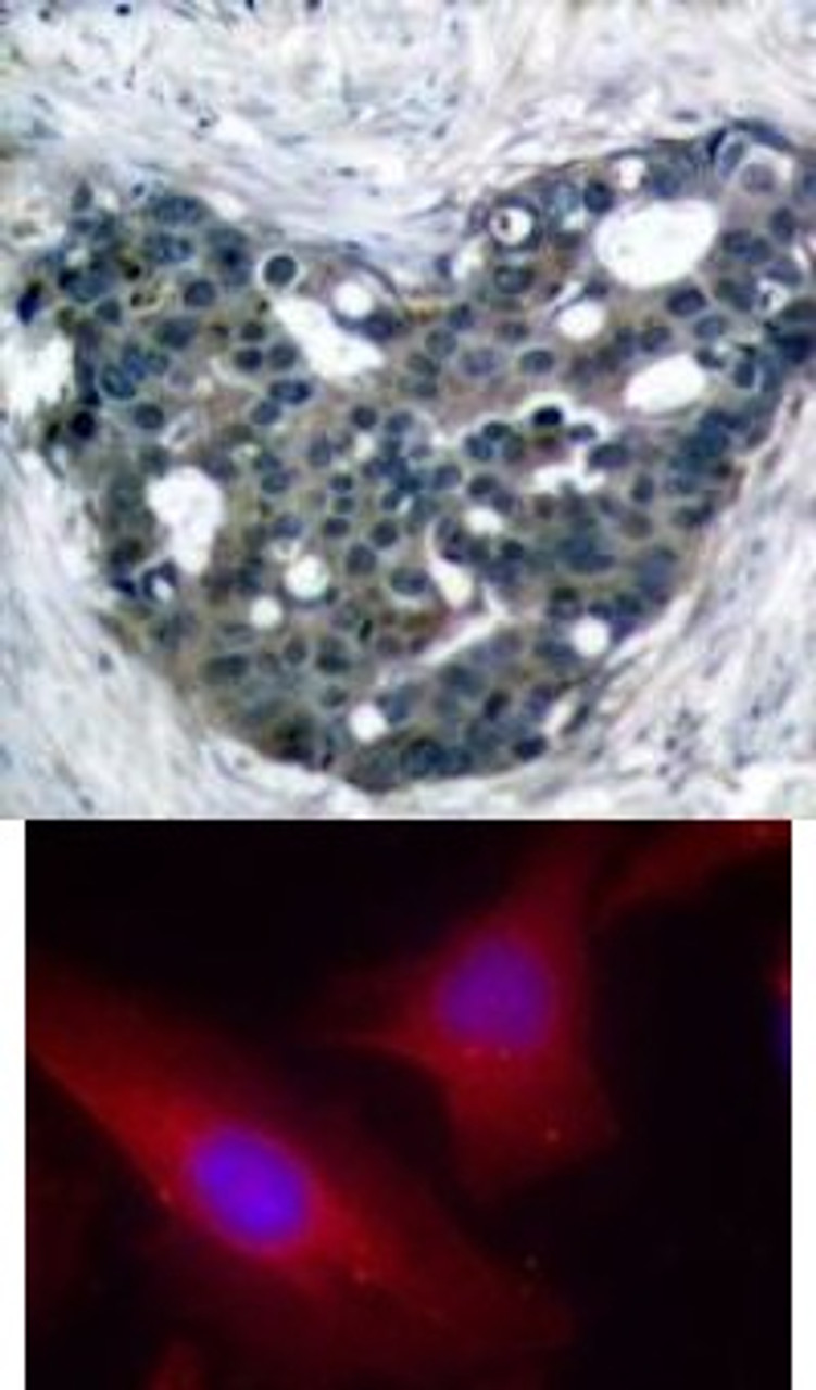 <b>Top Image:</b> Immunohistochemical analysis of paraffin-embedded human breast carcinoma tissue using p56Dok-2 (Ab-299) .<b>Bottom Image:</b> Immunofluorescence staining of methanol-fixed HeLa cells using p56Dok-2 (Ab-299) .