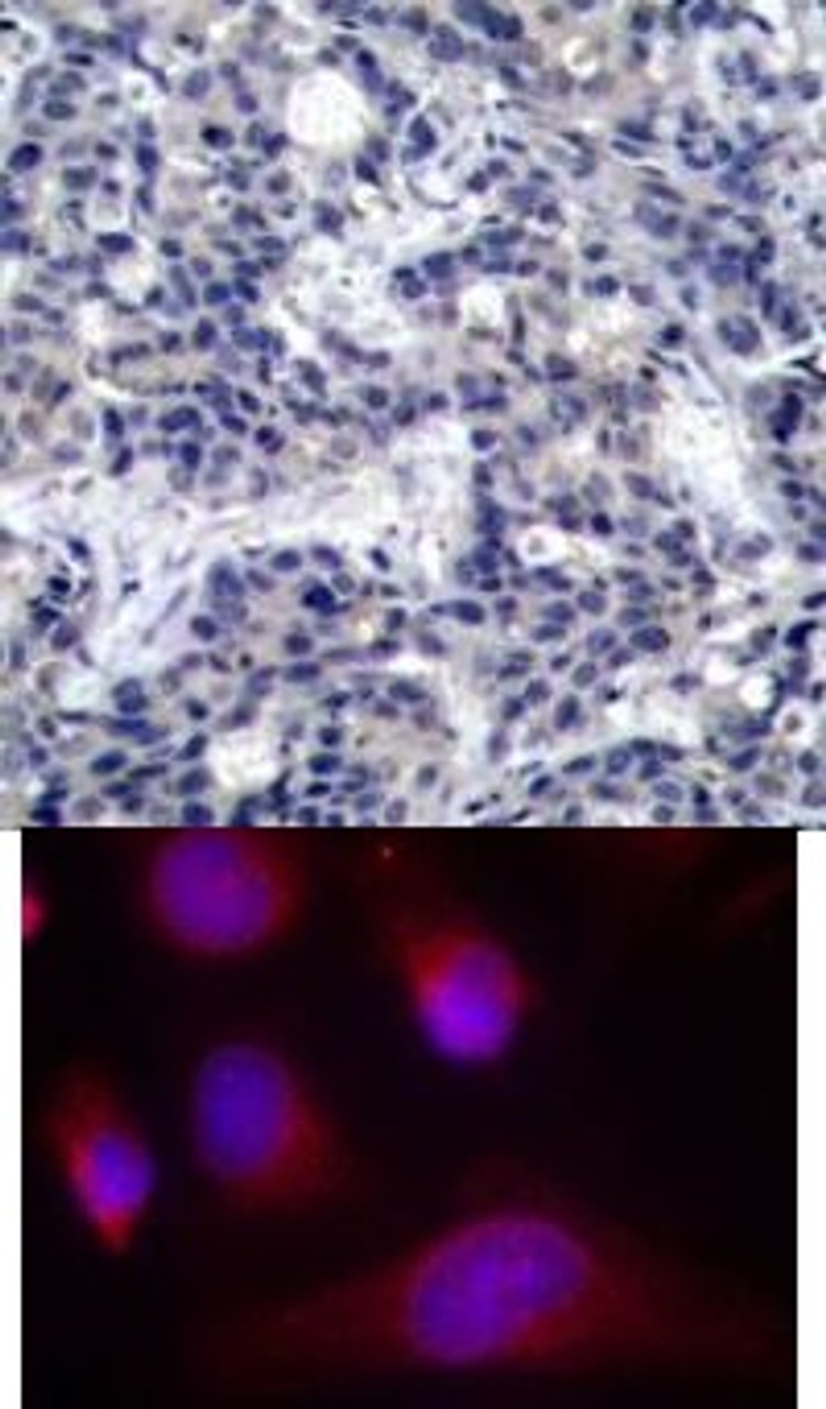 <b>Top Image:</b> Immunohistochemical analysis of paraffin-embedded human breast carcinoma tissue using PKR (Ab-446) .<b>Bottom Image:</b> Immunofluorescence staining of methanol-fixed HeLa cells using PKR (Ab-446) .