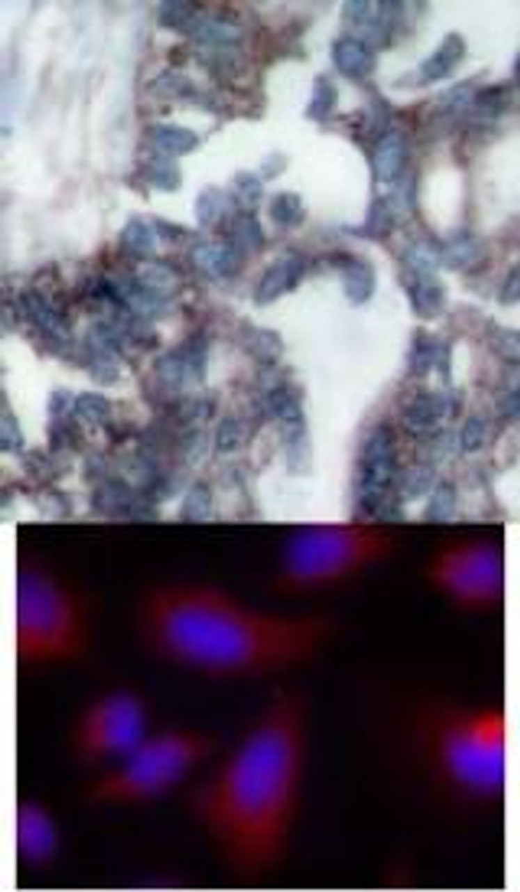 <b>Top Image:</b> Immunohistochemical analysis of paraffin-embedded human breast carcinoma tissue using p70 S6 Kinase (Ab-424) .<b>Bottom Image:</b> Immunofluorescence staining of methanol-fixed HeLa cells using p70 S6 Kinase (Ab-424) .