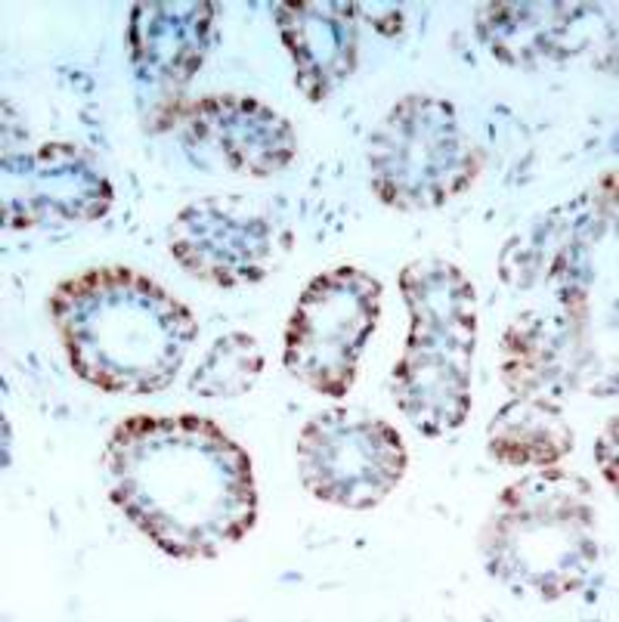 Immunohistochemical analysis of paraffin-embedded human breast carcinoma tissue using BIM (Ab-69) .
