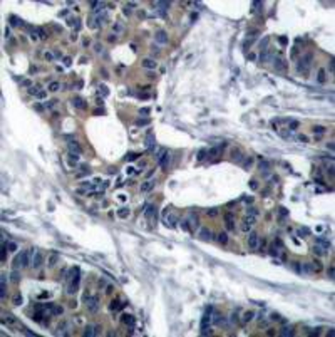Immunohistochemical analysis of paraffin-embedded human breast carcinoma tissue using MEK1 (Ab-291) .