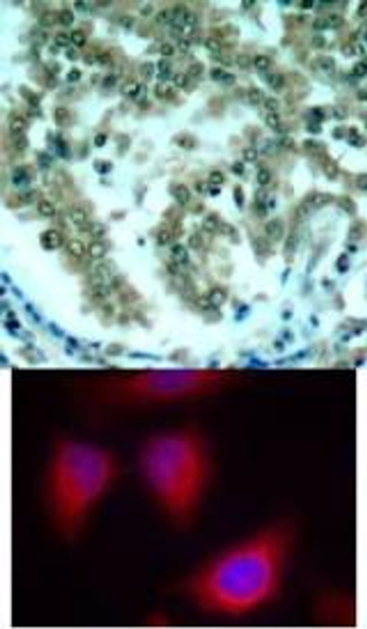 <b>Top Image:</b> Immunohistochemical analysis of paraffin-embedded human lung carcinoma tissue using PKC&#920; (Ab-676) .<b>Bottom Image:</b> Immunofluorescence staining of methanol-fixed HeLa cells using PKC&#920; (Ab-676) .