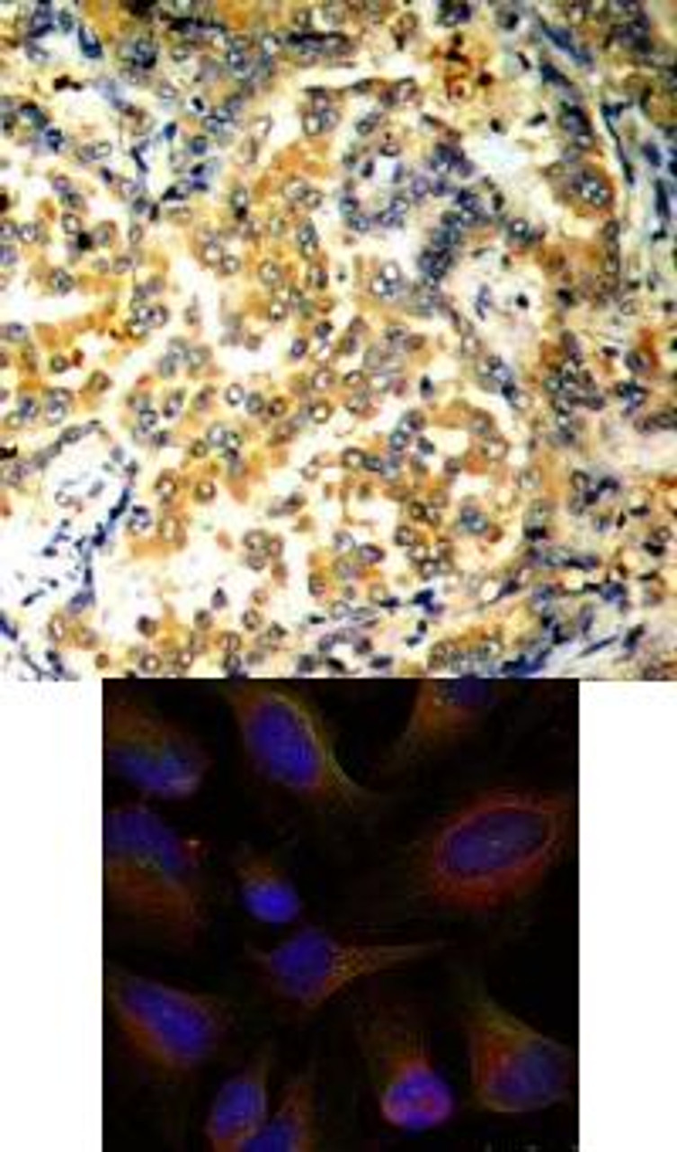 <b>Top Image:</b> Immunohistochemical analysis of paraffin-embedded human lung carcinoma tissue using NF&#954;B-p100/p52 (Ab-872) .<b>Bottom Image:</b> Immunofluorescence staining of methanol-fixed HeLa cells using NF&#954;B-p100/p52 (Ab-872) .