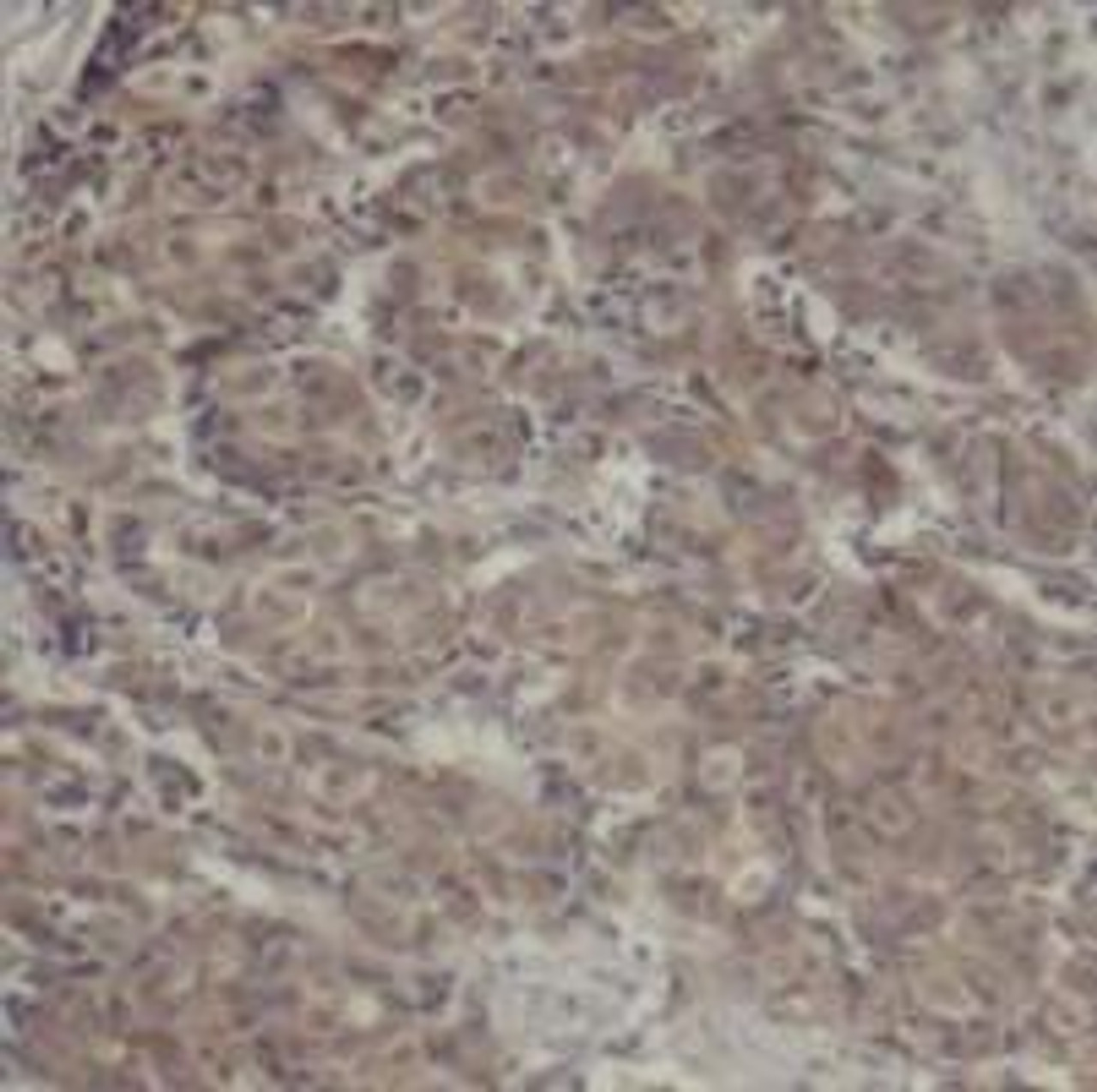 Immunohistochemical analysis of paraffin-embedded human breast carcinoma tissue using CREB (Ab-142) .
