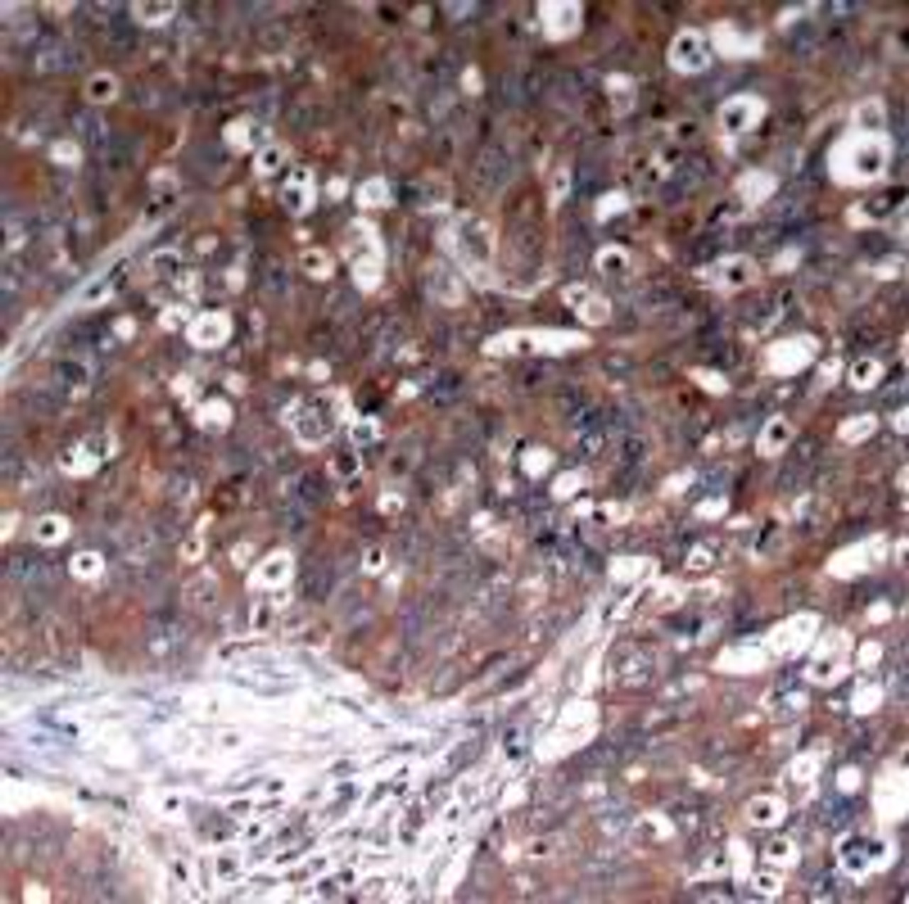 Immunohistochemical analysis of paraffin-embedded human breast carcinoma tissue using IGF-1R (Ab-1280) .