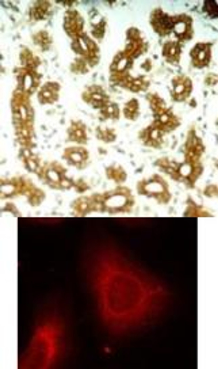 <b>Top Image:</b> Immunohistochemical analysis of paraffin-embedded human breast carcinoma tissue using Keratin 8 (Ab-74) .<b>Bottom Image:</b> Immunofluorescence staining of methanol-fixed HeLa cells using Keratin 8 (Ab-74) .