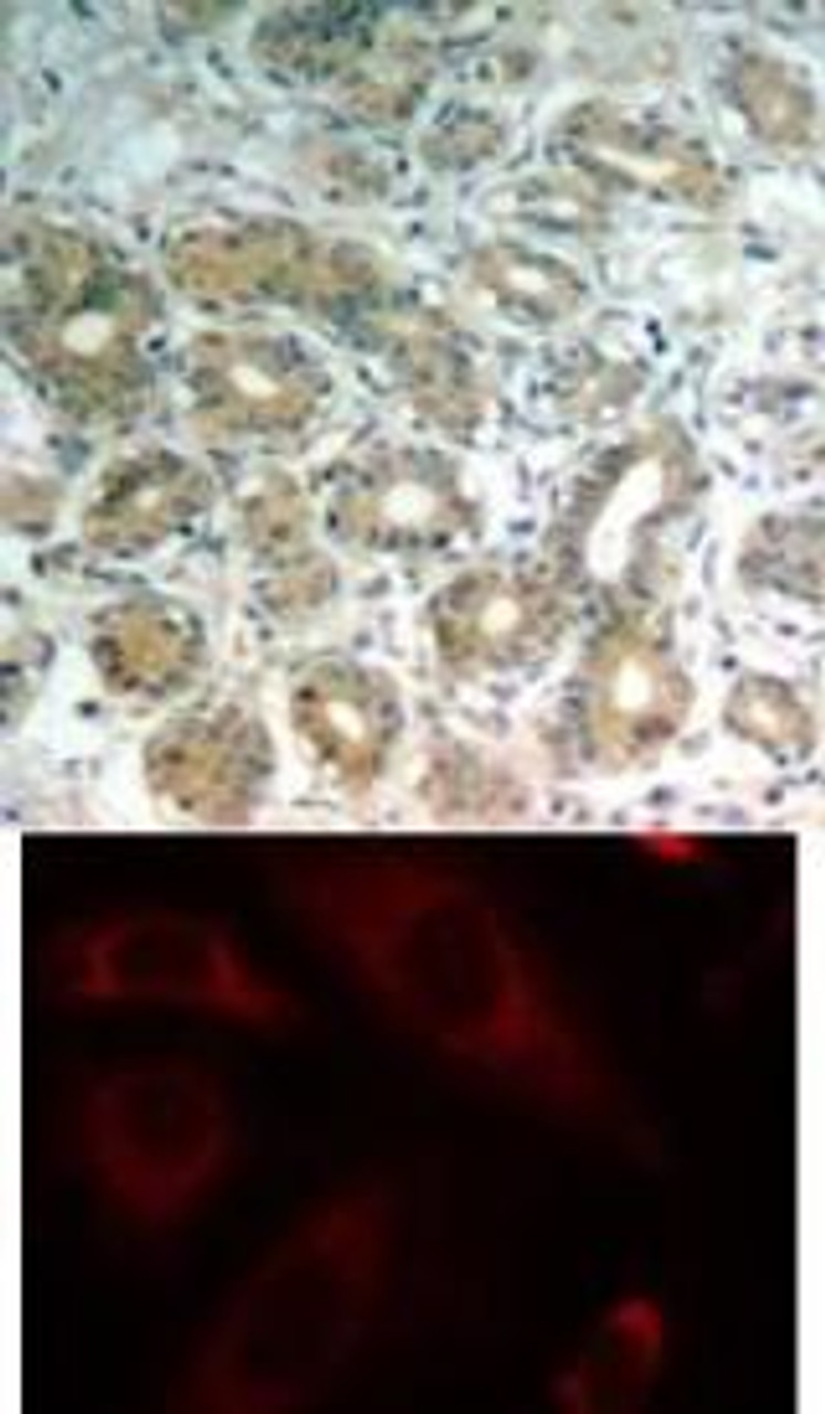 <b>Top Image:</b> Immunohistochemical analysis of paraffin-embedded human breast carcinoma tissue using SHP-2 (Ab-542) .<b>Bottom Image:</b> Immunofluorescence staining of methanol-fixed HeLa cells using SHP-2 (Ab-542) .