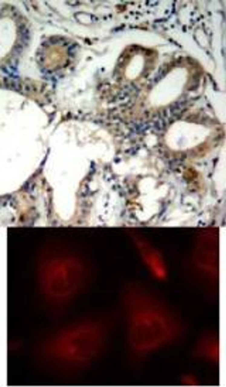 <b>Top Image:</b> Immunohistochemical analysis of paraffin-embedded human breast carcinoma tissue using SHP-2 (Ab-580) .<b>Bottom Image:</b> Immunofluorescence staining of methanol-fixed HeLa cells using SHP-2 (Ab-580) .