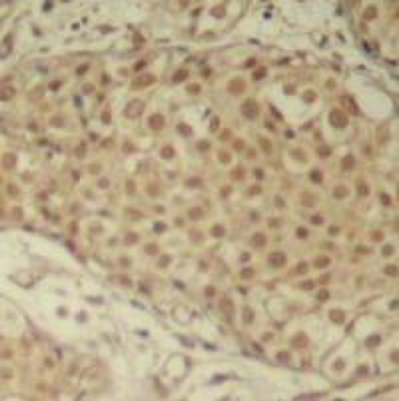 Immunohistochemical analysis of paraffin-embedded human breast carcinoma tissue using Smad2 (Ab-220) .