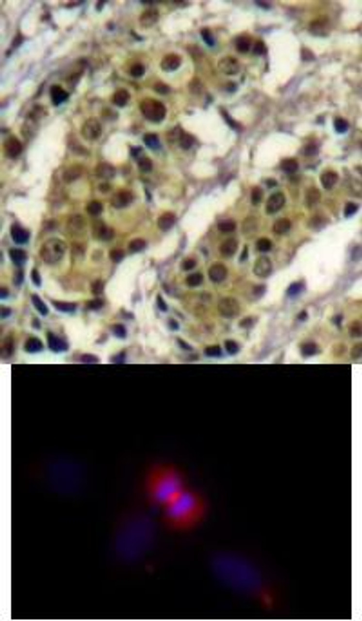 <b>Top Image:</b> Immunohistochemical analysis of paraffin-embedded human breast carcinoma tissue using AKT1 (Ab-450) .<b>Bottom Image:</b> Immunofluorescence staining of methanol-fixed HeLa cells using AKT1 (Ab-450) .