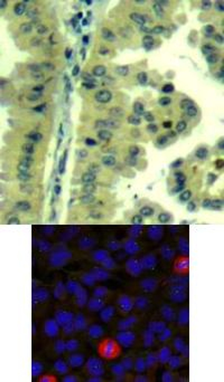 <b>Top Image:</b> Immunohistochemical analysis of paraffin-embedded human lung carcinoma tissue using eIF4G (Ab-1232) .<b>Bottom Image:</b> Immunofluorescence staining of methanol-fixed HeLa cells using eIF4G (Ab-1232) .