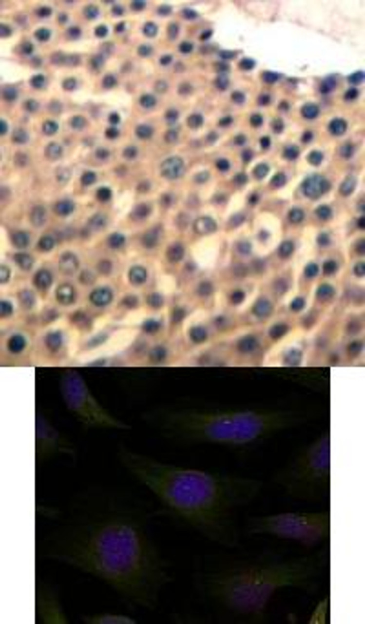 <b>Top Image:</b> Immunohistochemical analysis of paraffin-embedded human lung carcinoma tissue using HDAC4/HDAC5/HDAC9 (Ab-246/259/220) .<b>Bottom Image:</b> Immunofluorescence staining of methanol-fixed HeLa cells using HDAC4/HDAC5/HDAC9 (Ab-246/259/220) .