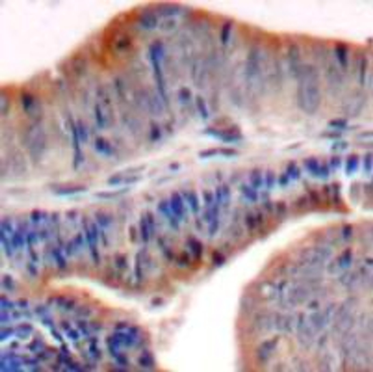 Immunohistochemical analysis of paraffin-embedded human colon carcinoma tissue using stathmin1 (Ab-62) .
