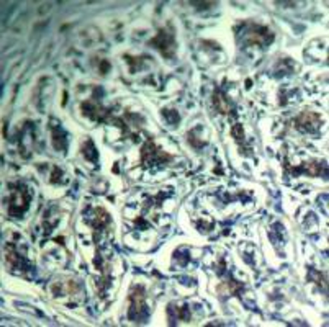 Immunohistochemical analysis of paraffin-embedded human breast carcinoma tissue using PLC-&#947;1 (Ab-771) .
