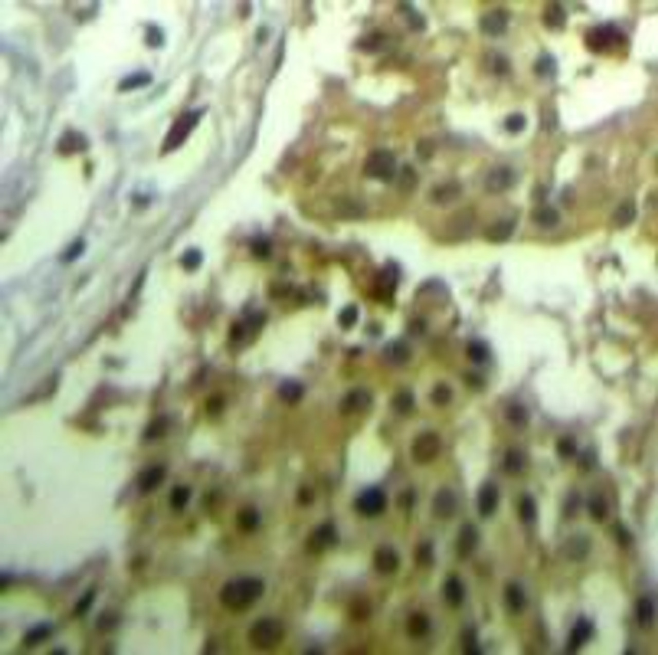 Immunohistochemical analysis of paraffin-embedded human breast carcinoma tissue using CDC2 (Ab-19) .