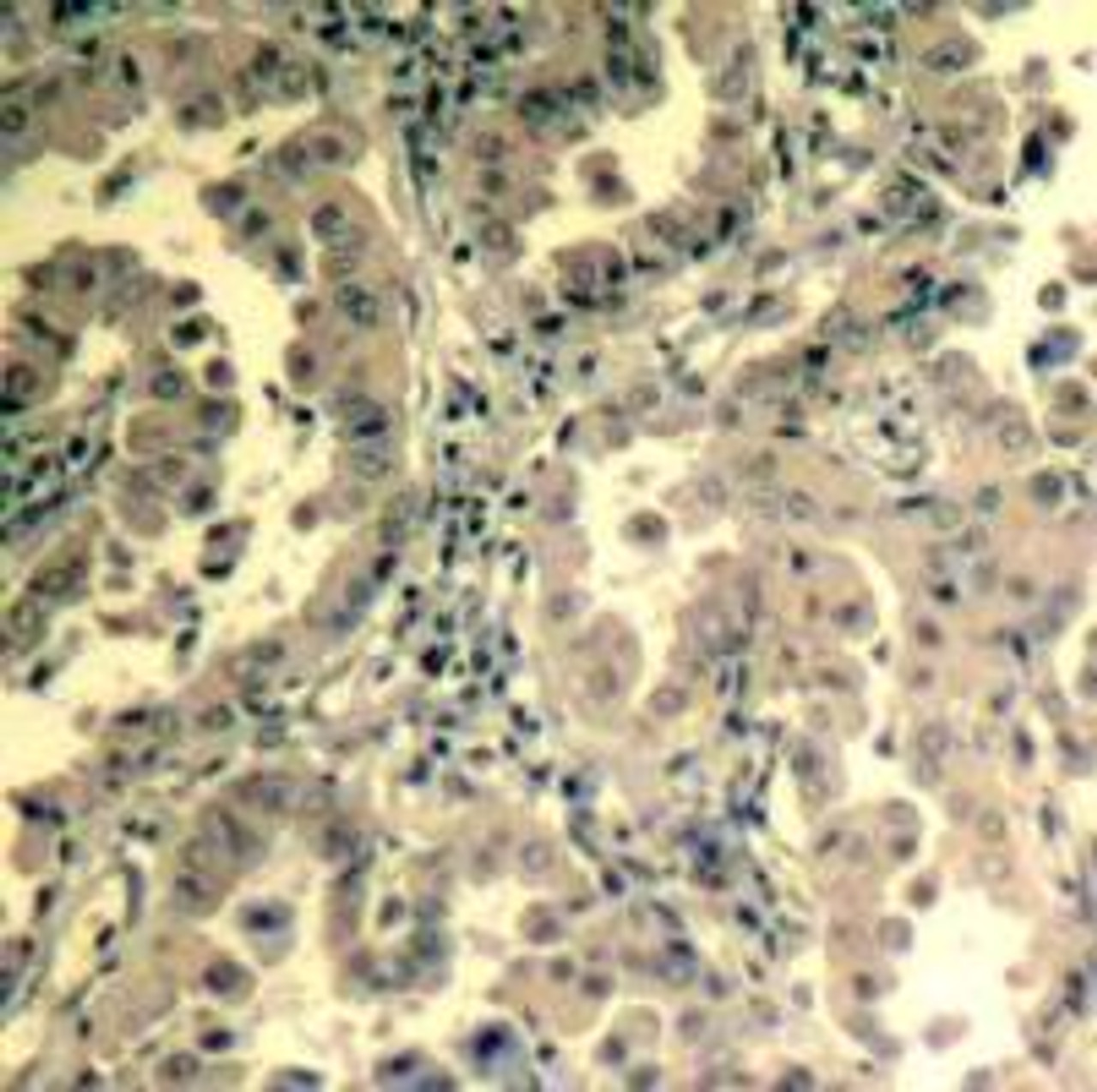 Immunohistochemical analysis of paraffin-embedded human lung carcinoma tissue using STAT2 (Ab-690) .