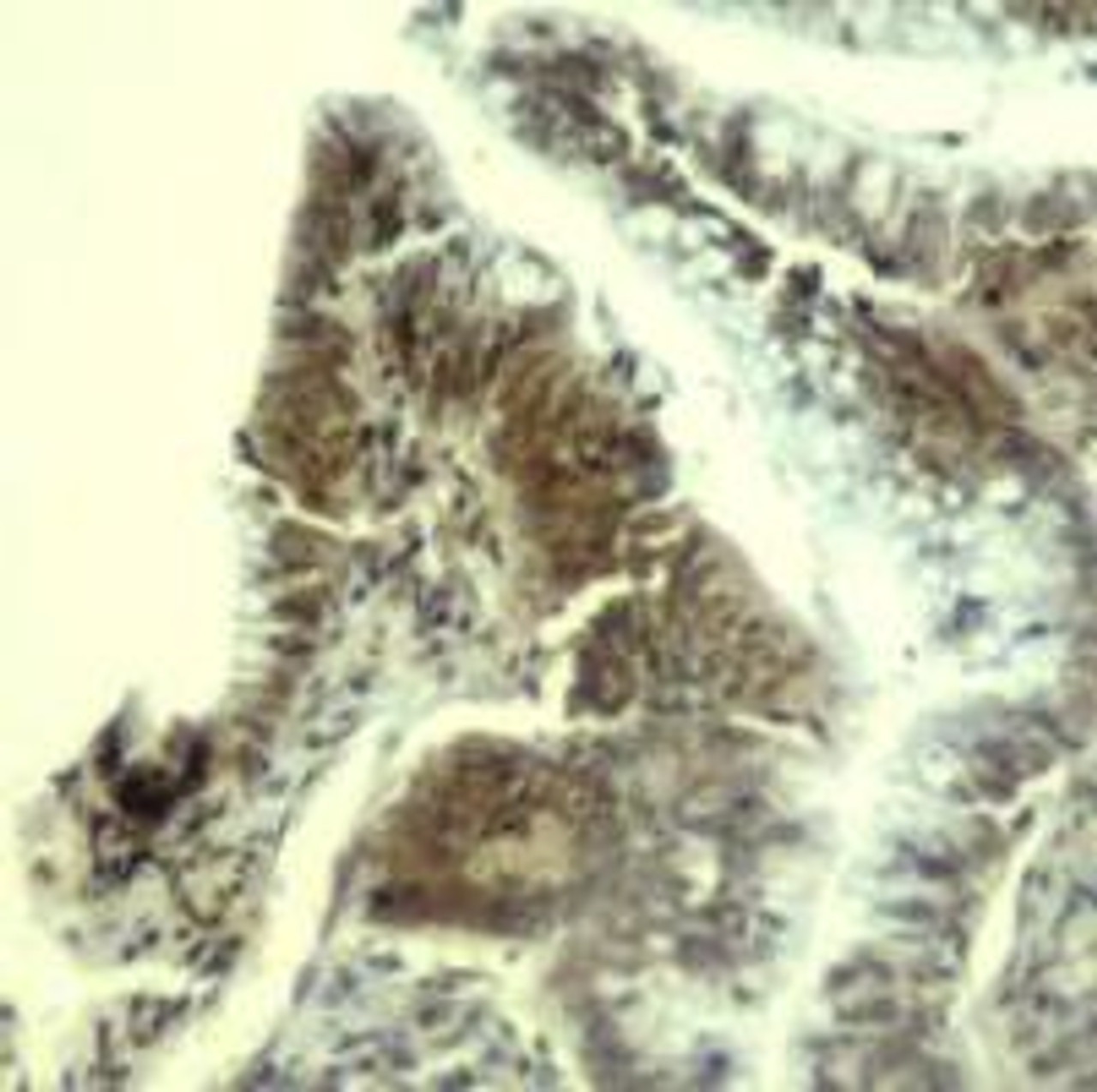 Immunohistochemical analysis of paraffin-embedded human colon carcinoma tissue using CDK6 (Ab-13) .