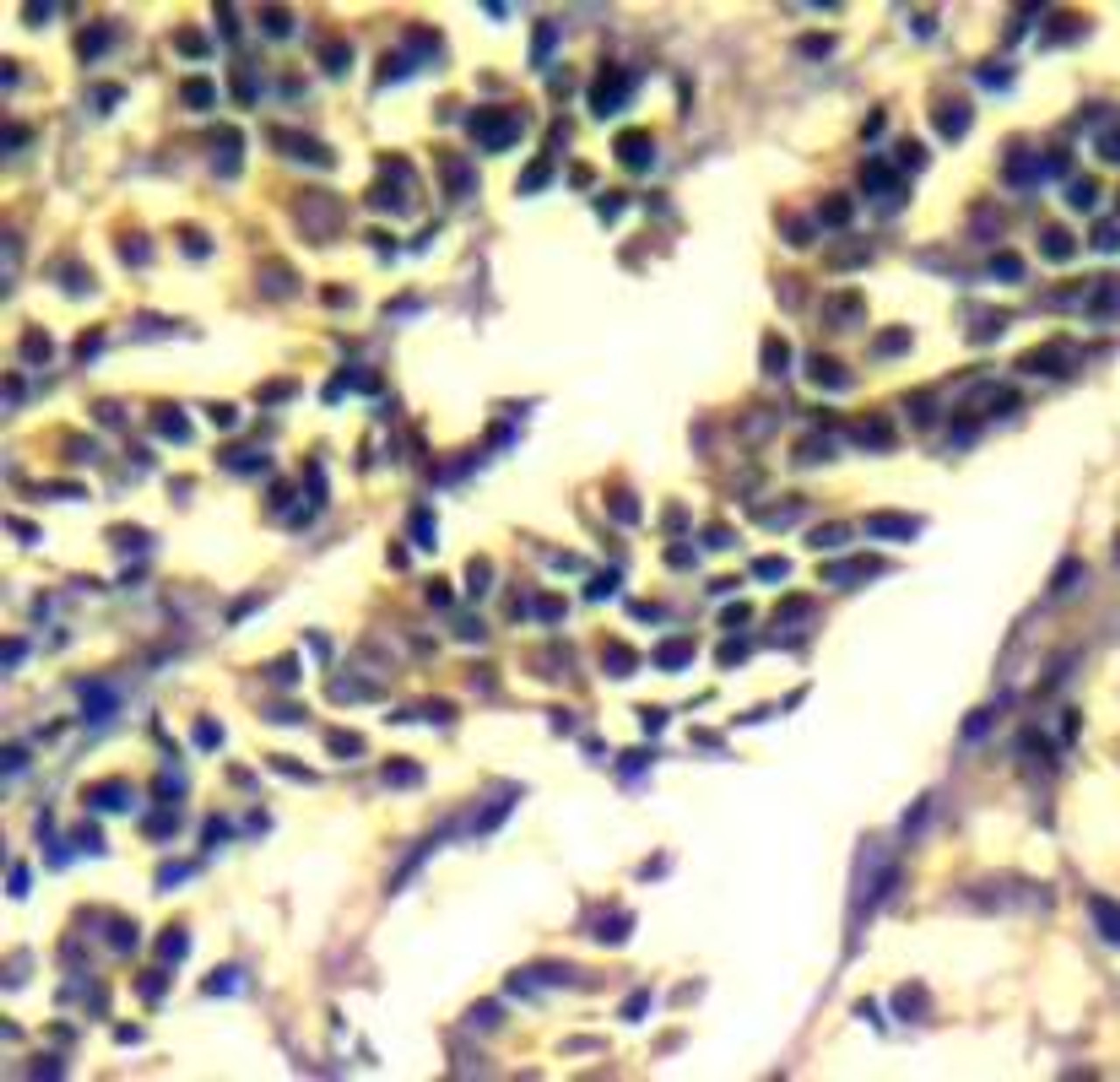 Immunohistochemical analysis of paraffin-embedded human breast carcinoma tissue using c-Cbl (Ab-700) .