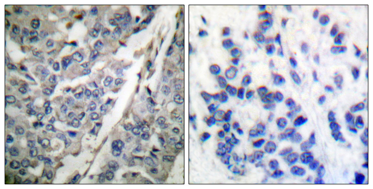 Immunohistochemical analysis of paraffin-embedded human breast carcinoma tissue using Synaptotagmin (phospho-Thr202) antibody (left) or the same antibody preincubated with blocking peptide (right) .