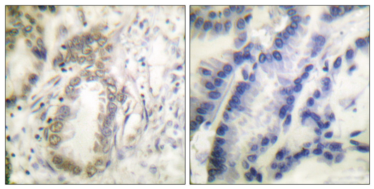 Immunohistochemical analysis of paraffin-embedded human colon carcinoma tissue using C/EBP-alpha (phospho-Ser21) antibody (left) or the same antibody preincubated with blocking peptide (right) .