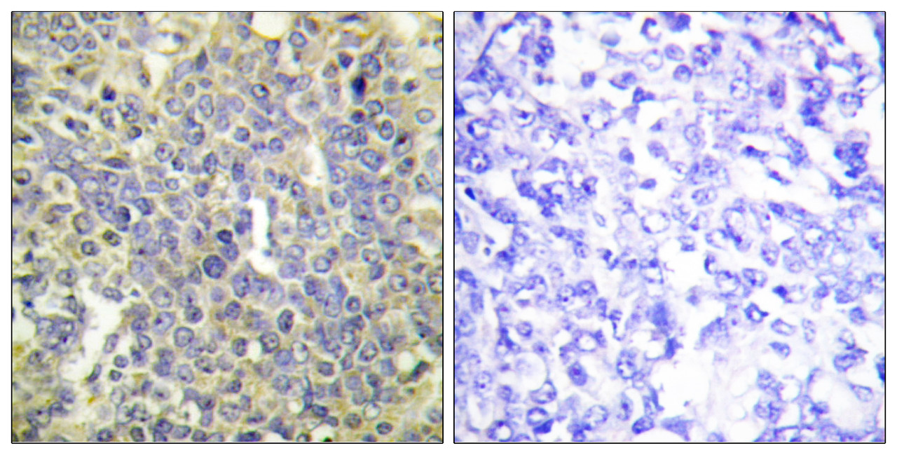 Immunohistochemical analysis of paraffin-embedded human lung carcinoma tissue using Caspase 9 (Phospho-Thr125) antibody (left) or the same antibody preincubated with blocking peptide (right) .