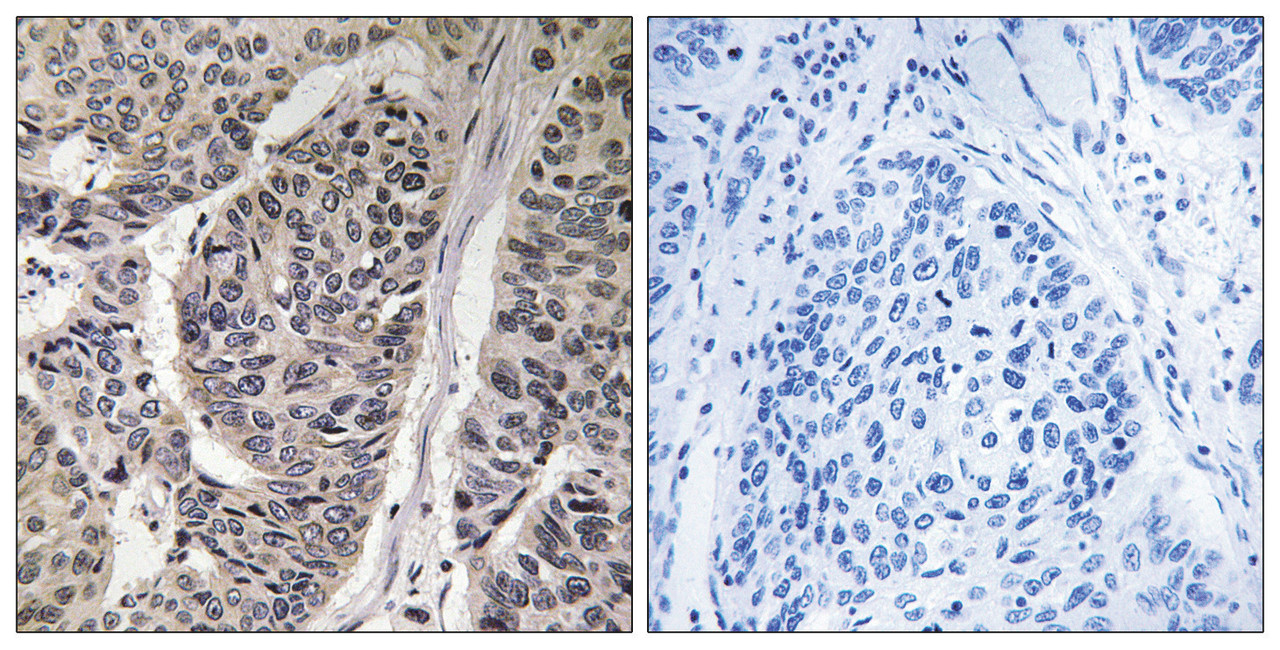 Immunohistochemical analysis of paraffin-embedded human breast carcinoma tissue, using p130 Cas (Phospho-Tyr410) antibody (left) or the same antibody preincubated with blocking peptide (right) .