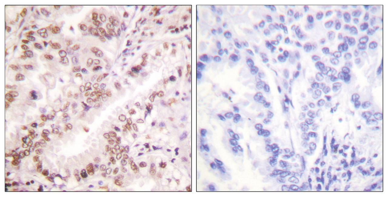 Immunohistochemical analysis of paraffin-embedded human lung carcinoma tissue using Estrogen Receptor-alpha (Phospho-Tyr537) antibody (left) or the same antibody preincubated with blocking peptide (right) .