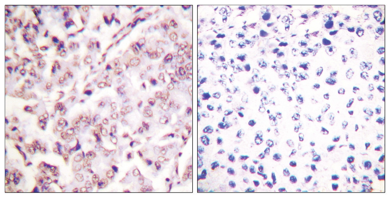 Immunohistochemical analysis of paraffin-embedded human breast carcinoma tissue, using ETS1 (Phospho-Thr38) antibody (left) or the same antibody preincubated with blocking peptide (right) .