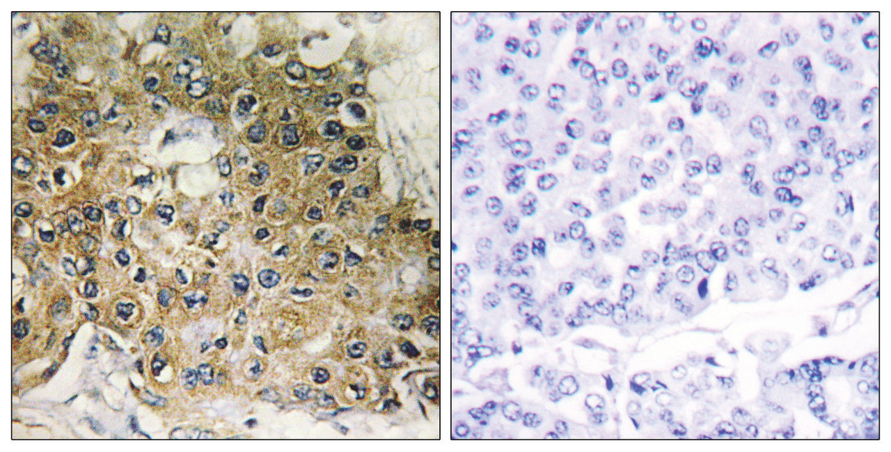 Immunohistochemical analysis of paraffin-embedded human breast carcinoma tissue using Integrin beta1 (Phospho-Thr789) antibody (left) or the same antibody preincubated with blocking peptide (right) .