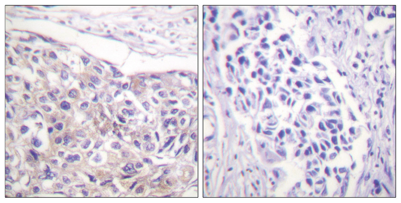 Immunohistochemical analysis of paraffin-embedded human breast carcinoma tissue using p90 RSK (Phospho-Thr573) antibody (left) or the same antibody preincubated with blocking peptide (right) .