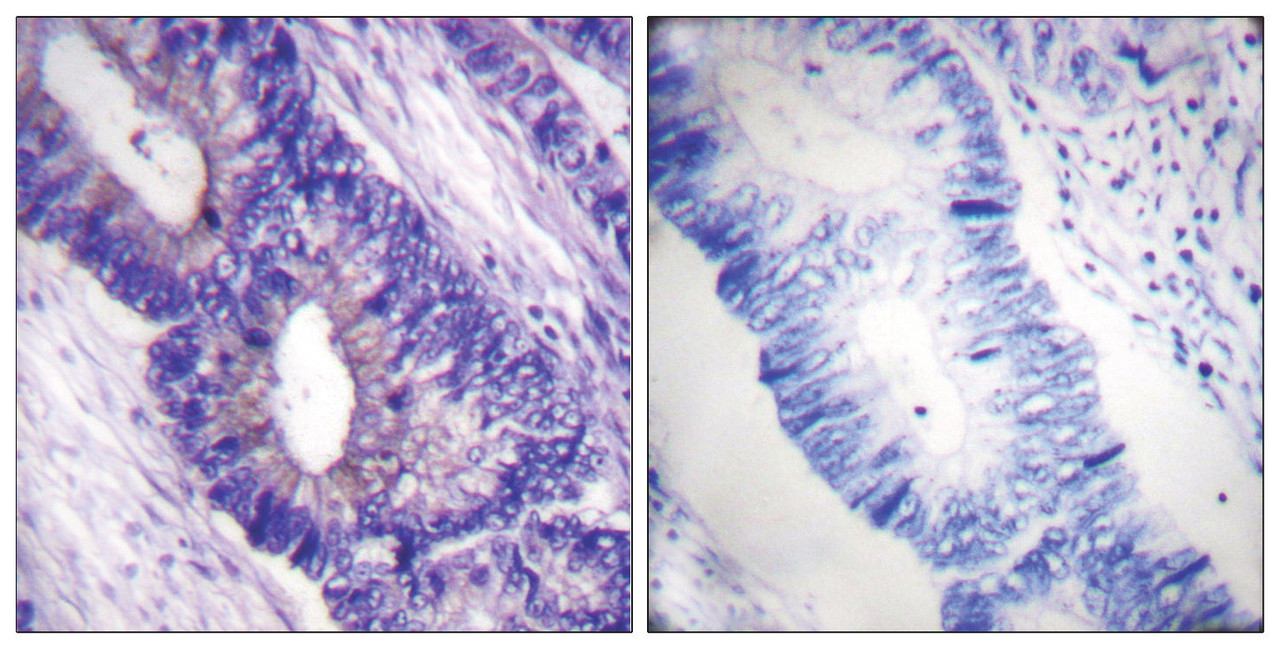 Immunohistochemical analysis of paraffin-embedded human colon carcinoma tissue using PKA alpha/beta CAT (Phospho-Thr197) antibody (left) or the same antibody preincubated with blocking peptide (right) .