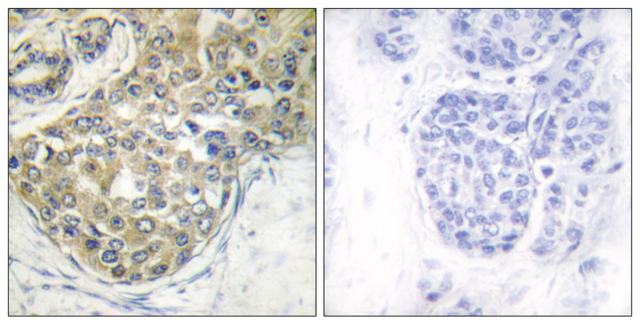 Immunohistochemical analysis of paraffin-embedded human breast carcinoma tissue using ACK1 (Phospho-Tyr284) antibody (left) or the same antibody preincubated with blocking peptide (right) .