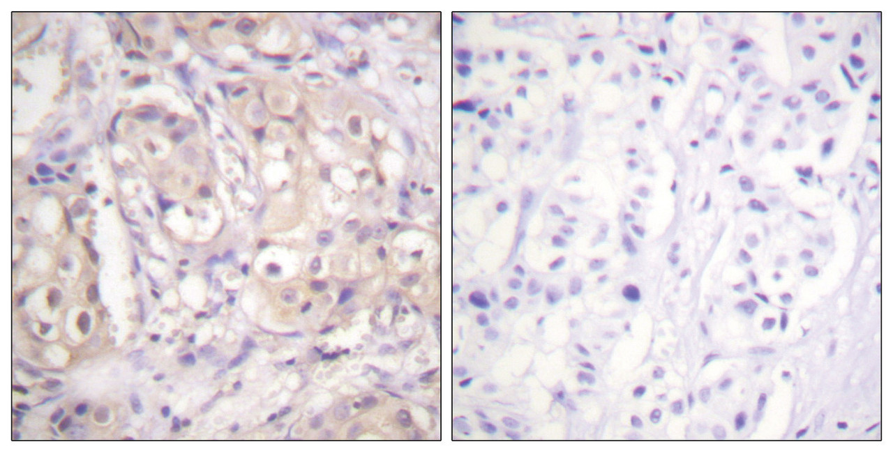 Immunohistochemical analysis of paraffin-embedded human breast carcinoma tissue using B-Raf (Phospho-Thr598) antibody (left) or the same antibody preincubated with blocking peptide (right) .