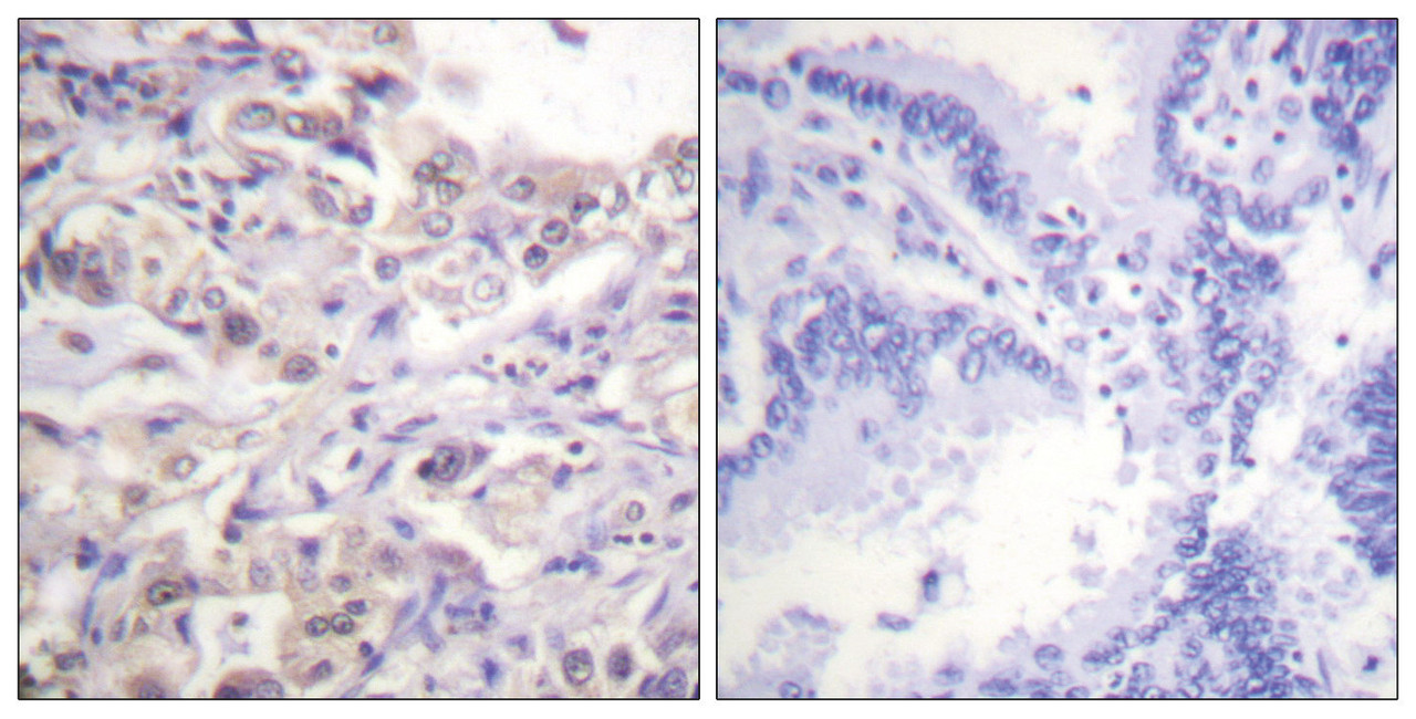 Immunohistochemical analysis of paraffin-embedded human lung carcinoma tissue using hnRPD (Phospho-Ser83) antibody (left) or the same antibody preincubated with blocking peptide (right) .