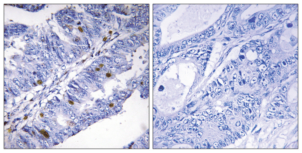 Immunohistochemical analysis of paraffin-embedded human colon carcinoma tissue using Nuclear Receptor NR4A1 (Phospho-Ser351) antibody (left) or the same antibody preincubated with blocking peptide (right) .