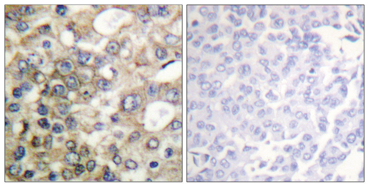 Immunohistochemical analysis of paraffin-embedded human breast carcinoma tissue using CD227/MUC1 (Phospho-Tyr1229) antibody (left) or the same antibody preincubated with blocking peptide (right) .