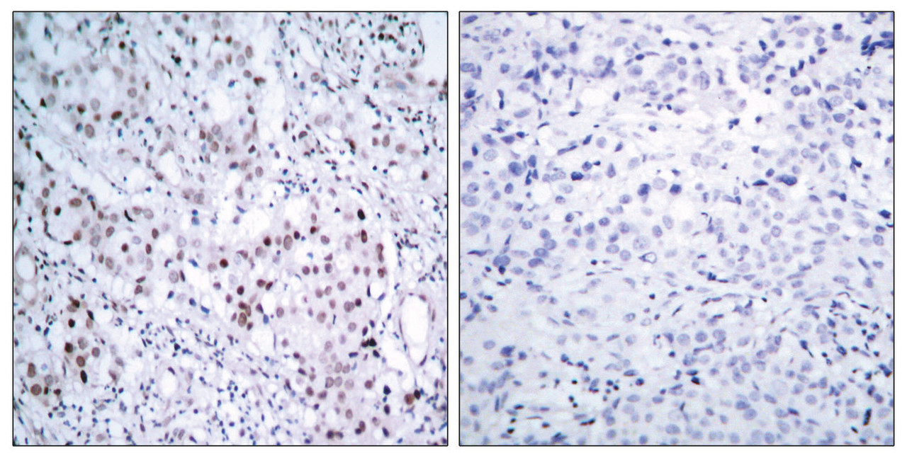 Immunohistochemical analysis of paraffin-embedded human breast carcinoma tissue, using c-Jun (Phospho-Ser63) antibody (left) or the same antibody preincubated with blocking peptide (right) .