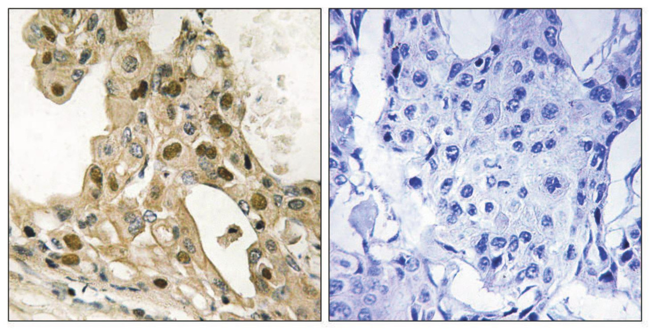 Immunohistochemical analysis of paraffin-embedded human breast carcinoma tissue using p53 (Phospho-Thr387) antibody (left) or the same antibody preincubated with blocking peptide (right) .