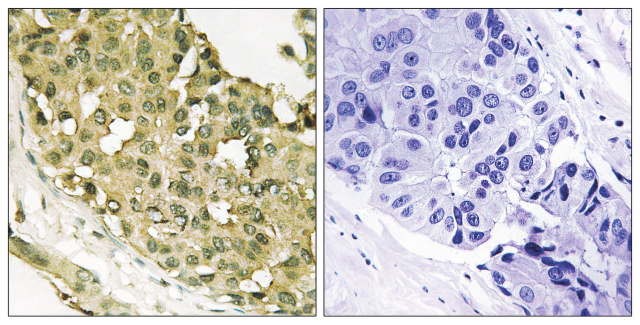 Immunohistochemical analysis of paraffin-embedded human breast carcinoma tissue using STMN1 (Phospho-Ser62) antibody (left) or the same antibody preincubated with blocking peptide (right) .