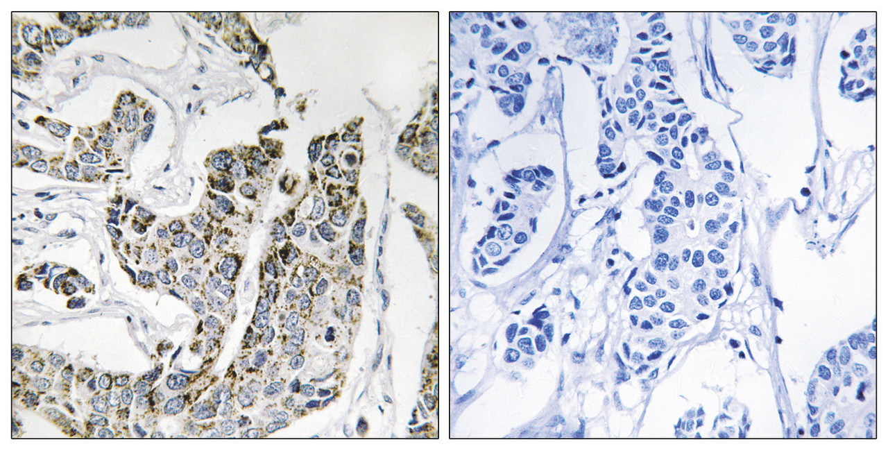 Immunohistochemical analysis of paraffin-embedded human breast carcinoma tissue using BLK (Phospho-Tyr501) antibody (left) or the same antibody preincubated with blocking peptide (right) .