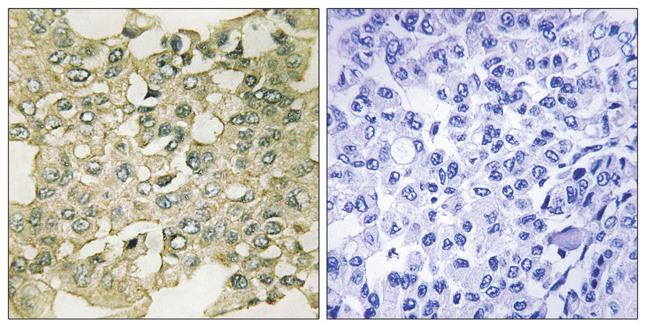 Immunohistochemical analysis of paraffin-embedded human breast carcinoma tissue using MYT1 (Phospho-Ser83) antibody (left) or the same antibody preincubated with blocking peptide (right) .