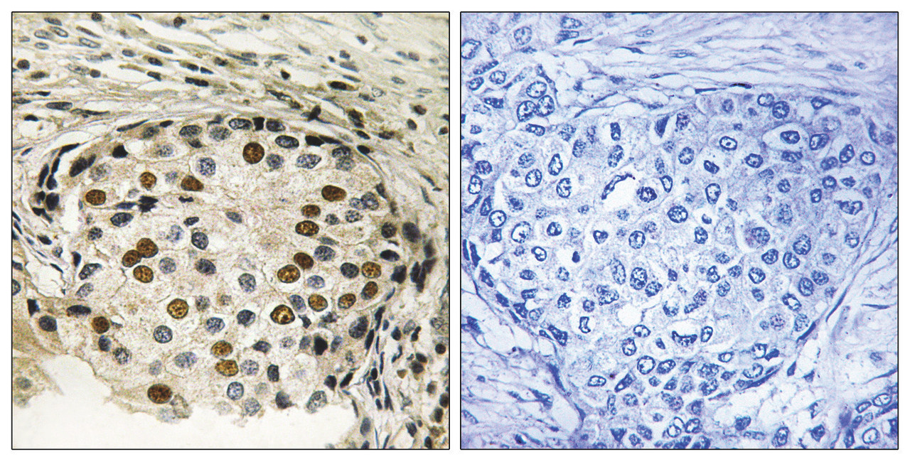Immunohistochemical analysis of paraffin-embedded human breast carcinoma tissue using OSR1 (Phospho-Thr185) antibody (left) or the same antibody preincubated with blocking peptide (right) .