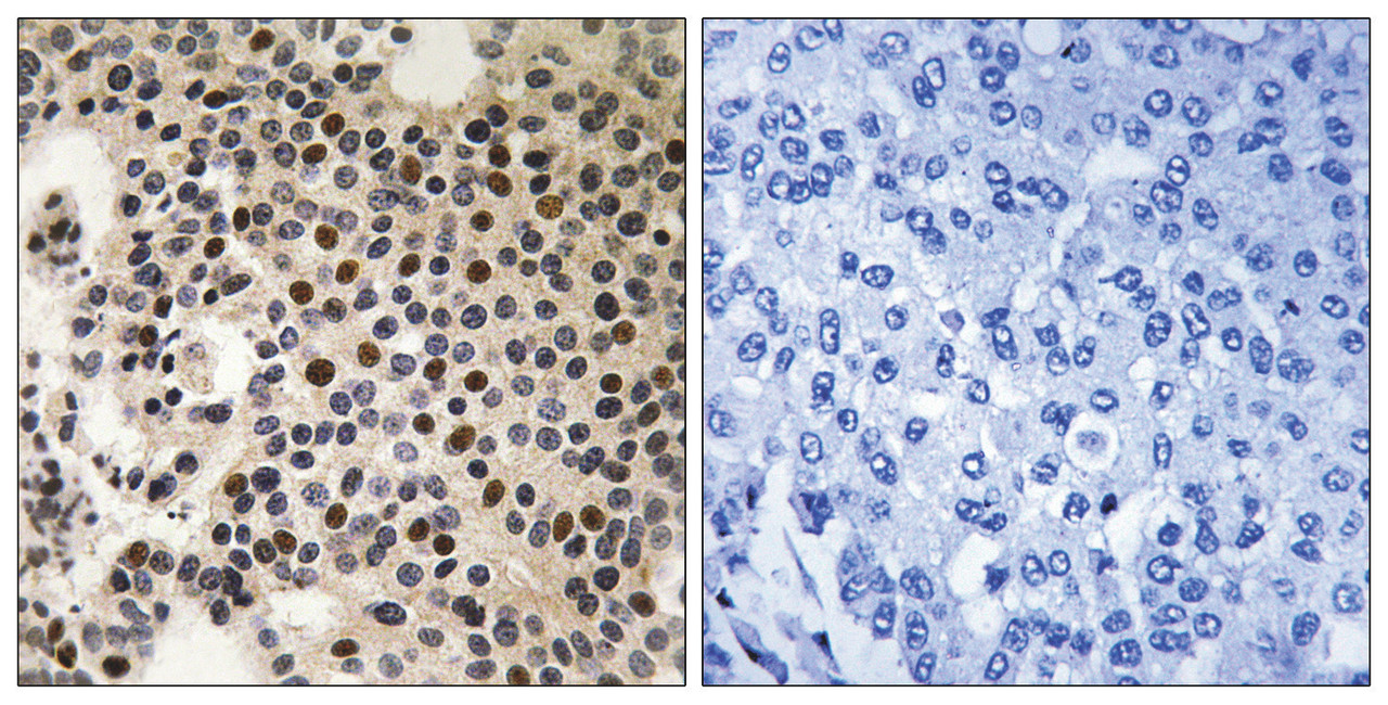 Immunohistochemical analysis of paraffin-embedded human breast carcinoma tissue, using PAK2 (Phospho-Ser197) antibody (left) or the same antibody preincubated with blocking peptide (right) .