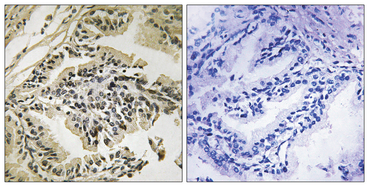 Immunohistochemical analysis of paraffin-embedded human prostate carcinoma tissue using PEK/PERK (Phospho-Thr982) antibody (left) or the same antibody preincubated with blocking peptide (right) .